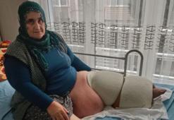 35 yıldır fil hastalığıyla mücadele ediyor