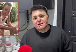 Kağıthane’de kuafördeki yangında vücudu yanan 15 yaşındaki Engin: Mücadeleyi kesinlikle bırakmasınlar ben yılmadım