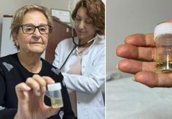 Alüminyum kabıyla yuttuğu hap, 4 yıl sonra akciğerinden çıkarıldı