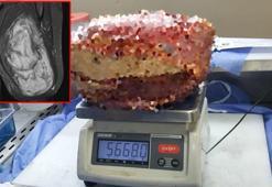 Diyarbakır’da, hastanın bacağından 5 kilo 668 gramlık kitle çıkarıldı