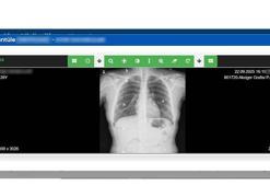 Sağlık Bakanlığı, 'Akciğer Görüntüleme Sistemi'ni hayata geçirdi