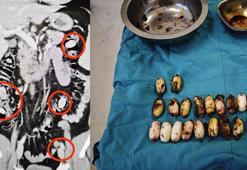 Midesinden 44 kapsül uyuşturucu madde bonzai çıktı