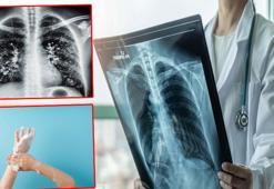 'Kışın solunum yolu enfeksiyonlarında artış doğal, hijyen şart'