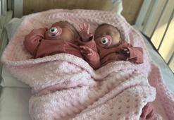 Prematüre ikizler, anjiyo ile hayata tutundu