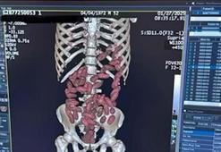 2025’te İstanbul Havalimanı’nda ‘yutucu’ kuryelerden 29,7 kilo uyuşturucu ele geçirildi