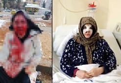 Eşinin kaldırım taşı ile dövdüğü Nazlı: Çıkarsa yarım bıraktığı işi tamamlar