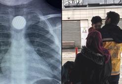 3 yaşındaki Bilal'in, yuttuğu 50 kuruş yemek borusunda takıldı