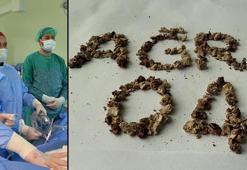 Daha önce 21 kez böbrek taşı operasyonu geçiren hastadan 295 taş çıkarıldı