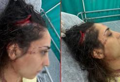 Bakkala giderken sokak köpeklerinin saldırısında yaralandı