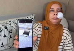 Elektrikli bisikleti ile kapağı kırık rögara düştü; yüzüne 14 dikiş atıldı