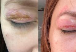 Güzellik salonundaki işlem sonrası gözünde hasar iddiasıyla yaptığı şikayet reddedildi; 'Uzmanına gidin' uyarısı yaptı