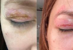 Güzellik salonundaki işlem sonrası gözünde hasar iddiasıyla yaptığı şikayet reddedildi; 'Uzmanına gidin' uyarısı yaptı