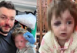 İkra ile babasının darbedilmesine ilişkin iddianame hazırlandı; çocuk skuter'ı 'silah' olarak sayıldı