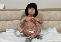 4 yaşındaki İbrahim, 'Kelebek hastalığı' nedeniyle kıyafet giyemiyor