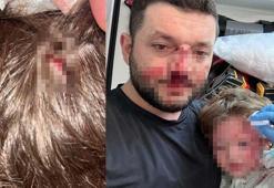 Kucağında bebeği ile darbedilen babanın oğlu, sokakta başına atılan taşla yaralandı