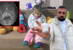 5 yaşındaki Polen, 2 yıldır burnunda tırnak makası zinciriyle yaşamış