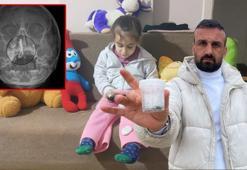 5 yaşındaki Polen, 2 yıldır burnunda tırnak makası zinciriyle yaşamış