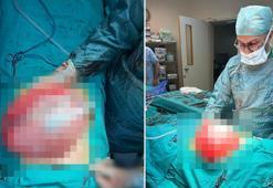 Kilolarından kurtulmak için doktora giden liseli kızın karnından 3,5 kilo ağırlığında kist çıktı