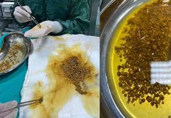 Karın ağrısı şikayetiyle gittiği hastanede safra kesesinden 2 bin 67 taş çıkarıldı