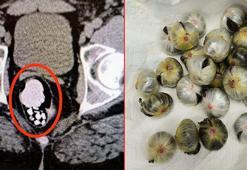 Midesinde uyuşturucu madde bulunan şüpheli, tutuklandı