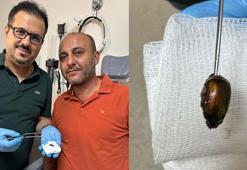 Ağrı ve işitme kaybı nedeniyle gittiği hastanede, kulağından böcek çıktı