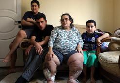 Fil hastası kadın, iyileşip çocuklarıyla ilgilenmek istiyor