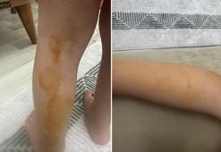 Sokak köpeğinin saldırısına uğrayan Erva yaralandı