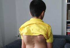 Skolyoz hastası Cihan, 7’nci ameliyat için destek bekliyor