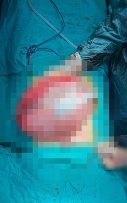 Kilolarından kurtulmak için doktora giden liseli kızın karnından 3,5 kilo ağırlığında kist çıktı