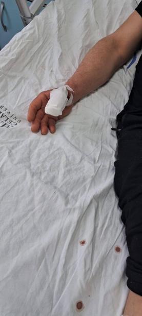 Köpek saldırısında parmağı koptu; o anlar kamerada