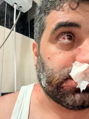 Tamir sırasında TIRın sağlam lastiği patladı; 1 yaralı