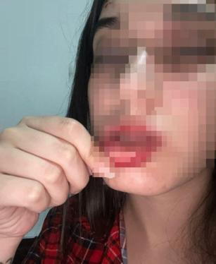 Eski sevgilisi tarafından darbedildiğini iddia edip, fotoğraflarını sosyal medyada paylaştı