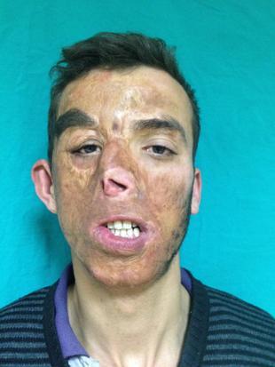 İlk yüz nakilli Uğur Acar, hayata 14 yıldır başka bir yüzle bakıyor