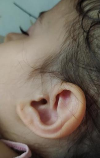 İzmit’te parkta 3 yaşındaki çocuğun kulağına kene yapıştı