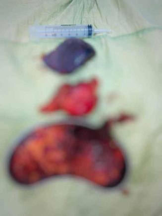 Karnından 2 kilo 200 gram ağırlığında tümör çıkarıldı