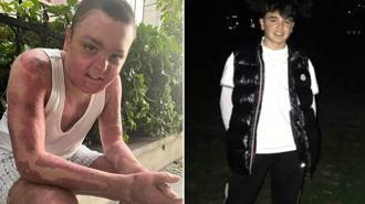 Kağıthane’de kuafördeki yangında tüm vücudu yanan 14 yaşındaki Engin'in tedavisi tamamlandı: Kapı sıkışınca çıkamadım yandım