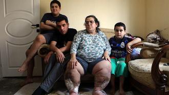 Fil hastası kadın, iyileşip çocuklarıyla ilgilenmek istiyor