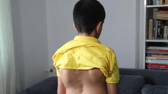 Skolyoz hastası Cihan, 7’nci ameliyat için destek bekliyor