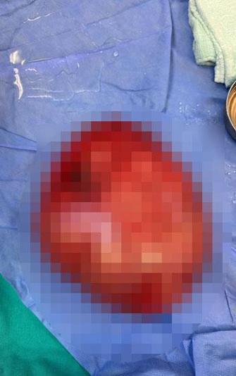 Kilolarından kurtulmak için doktora giden liseli kızın karnından 3,5 kilo ağırlığında kist çıktı