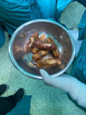 İranlı şüphelinin bağırsağından uyuşturucu çıktı