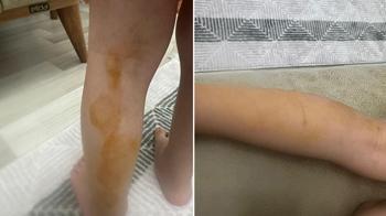 Sokak köpeğinin saldırısına uğrayan Erva yaralandı
