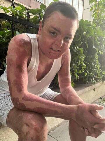 Kağıthane’de kuafördeki yangında vücudu yanan 15 yaşındaki Engin: Mücadeleyi kesinlikle bırakmasınlar ben yılmadım