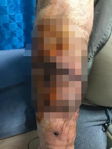 Yürüyüş yaparken köpekler saldırdı; koluna 40, bacağına 36 dikiş atıldı