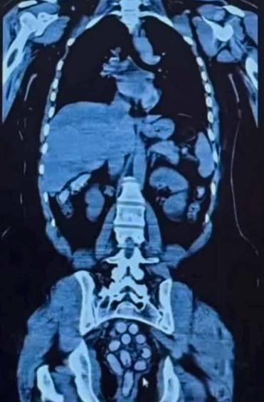 Midesinde 1,5 kilo metamfetaminle yakalanan 2 kadın kurye tutuklandı