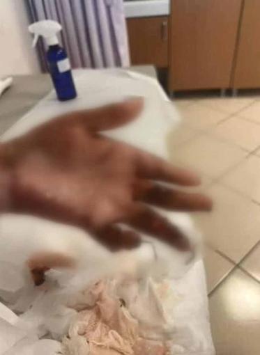 Kağıthane’de kuafördeki yangında vücudu yanan 15 yaşındaki Engin: Mücadeleyi kesinlikle bırakmasınlar ben yılmadım