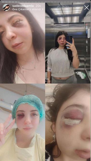 Sokak ortasında darbedilen Damla: Artık yüzümün sol tarafını hissetmiyorum