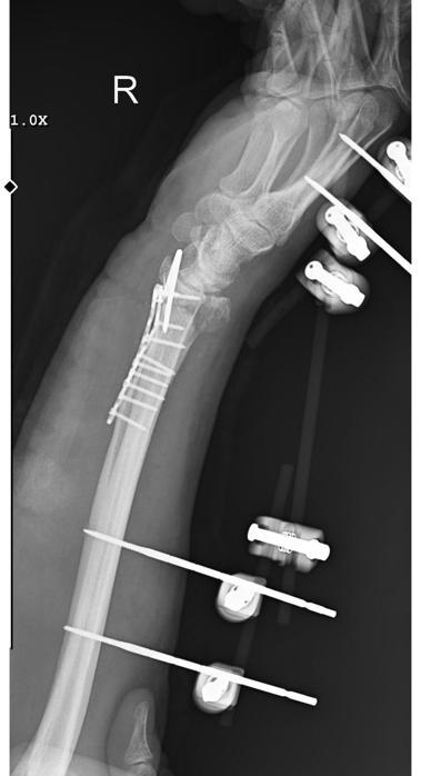 Köpeklerin saldırısından kaçarken düştü, kolu kırıldı