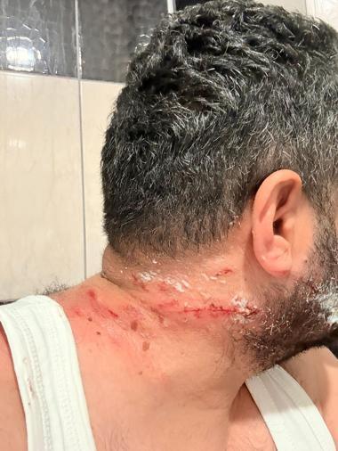 Tamir sırasında TIRın sağlam lastiği patladı; 1 yaralı