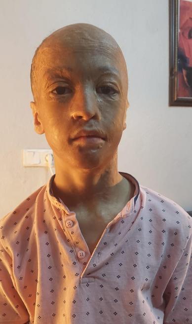 Yangında yaralanan 9 yaşındaki Halil, 3üncü kez doku nakli için bekliyor