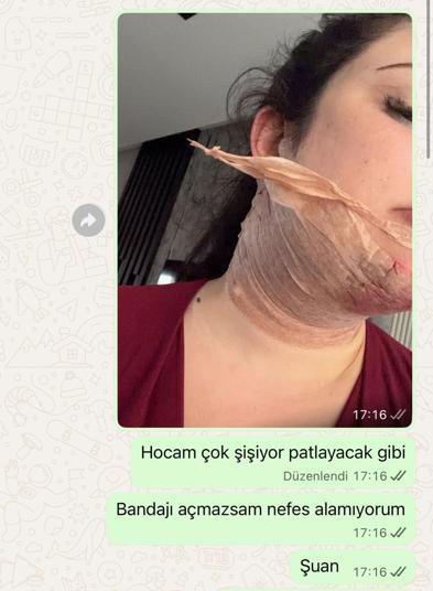 Estetik ameliyatı sonrası yoğun bakımda 2 gün tedavi gördü, doktor hakkında şikayetçi oldu